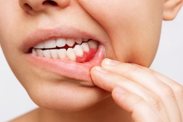 Diş eti ağrısı neden olur? Nasıl geçer?
