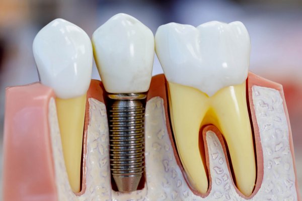 Diş implantı nedir? Nasıl yapılır?