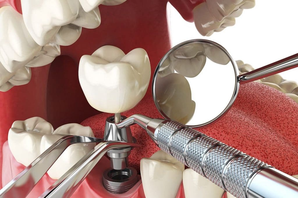 Diş Kayıplarında İmplant ile Birlikte Yapılan Protezler