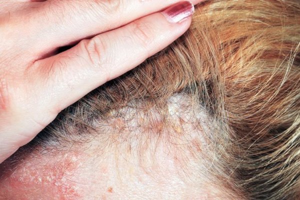 Saç diplerinde yara neden olur? Saç derisinde çıkan yaralara ne iyi gelir?