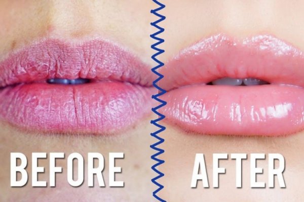 Çatlayan dudaklar nasıl iyileşir? Dudak çatlağı için evde bakım yöntemleri