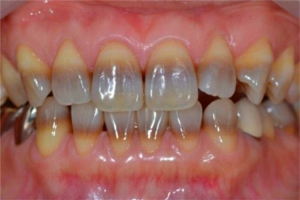 Diş dipleri neden kararır? Kararan diş dipleri nasıl beyazlar?