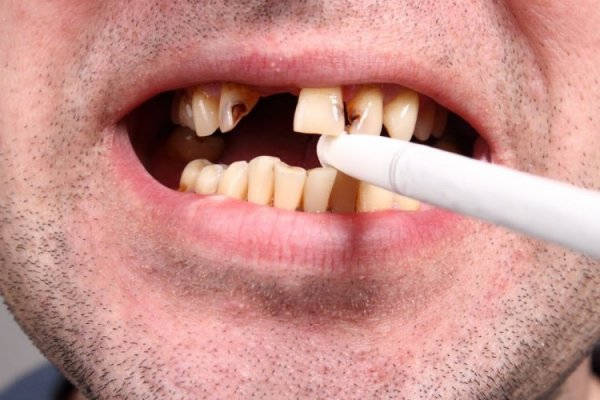 Sigara içmek dişleri çürütür mü? Sigara içen birinin dişleri nasıl beyazlar?