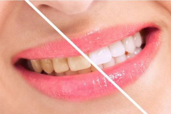 Doğal yöntemlerle diş beyazlatma nasıl yapılır? Bu yöntemlerle dişleriniz inci gibi olacak!