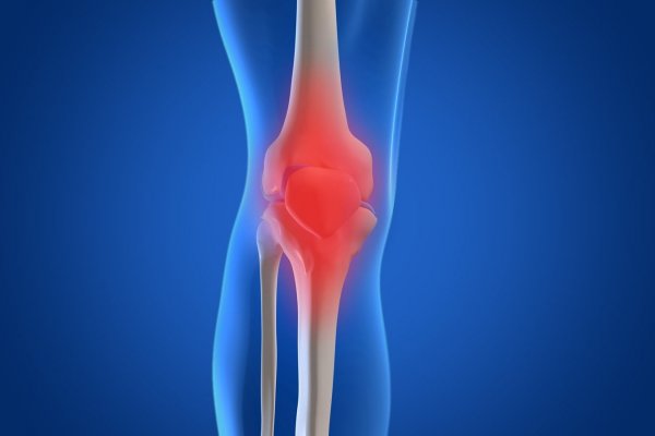 Osteoartrit nedir? Osteoartrit Belirtileri ve Tedavisi